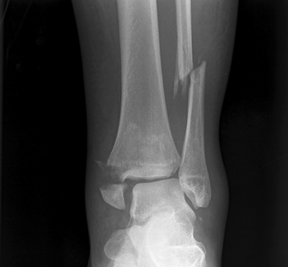 fibula fx.jpg